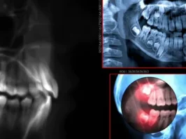Full Mouth Rehablitation "All On 4"