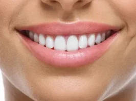 Direct Laminate/ Veener - Per Tooth
