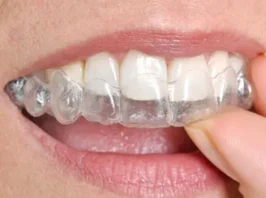 Indirect Laminate/ Veener - Per Tooth