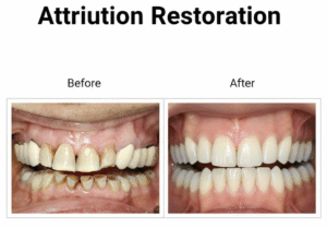 Attriution Restoration