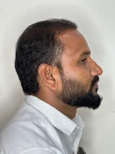 Procedure Hair Transplant 2