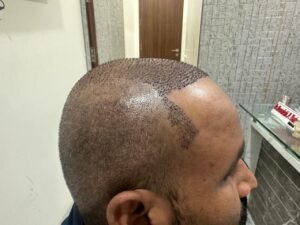 Procedure Hair Transplant 2