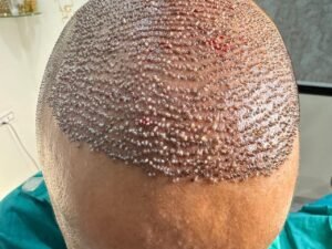 Graft Images (Hair Transplant)