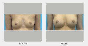 Breast Augmentation