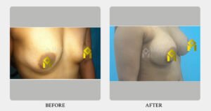 Breast Augmentation