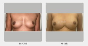 Breast Augmentation