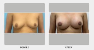 Breast Augmentation & Lift