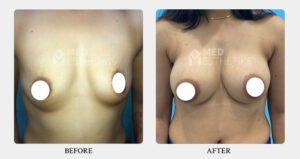 Breast Augmentation