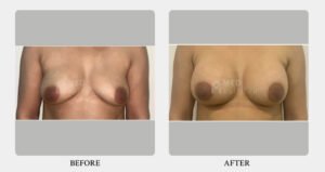 Breast Lift
