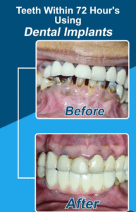 Immediate Implant Procedure
