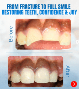 Ellis Tooth Fracture/ Smile Design