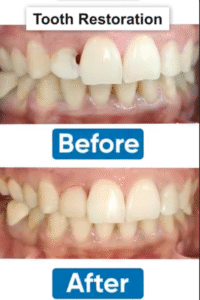 Tooth Restoration