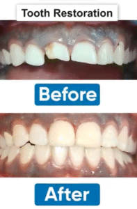 Ellis Tooth Fracture Restoration