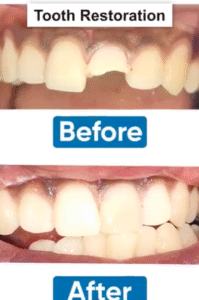 Ellis Tooth Fracture Restoration