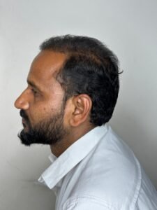 Hair Transplant Post 6 Months
