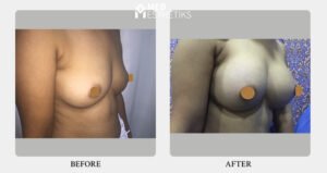 Breast Augmentation
