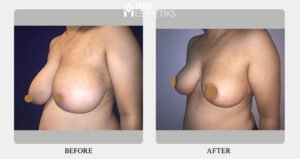Breast Reduction